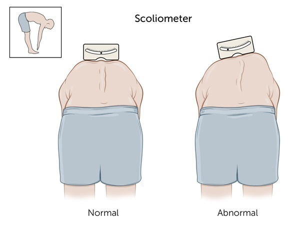 scoliosis screening 